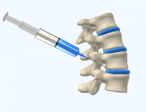 Beyond Epidurals  Management of Back Pain